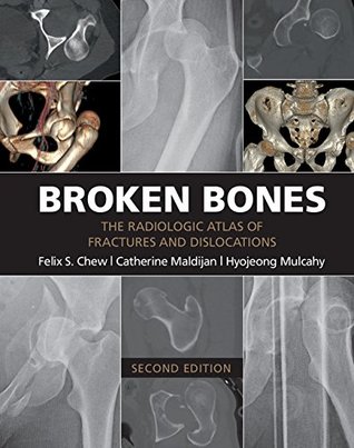 Full Download Broken Bones: The Radiologic Atlas of Fractures and Dislocations - Felix S. Chew file in ePub